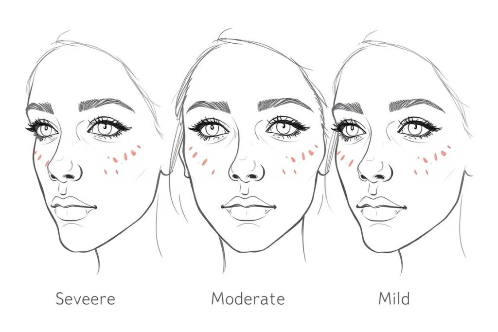 Line drawing showing the progression of perioral dermatitis improvement over time with red light therapy treatment