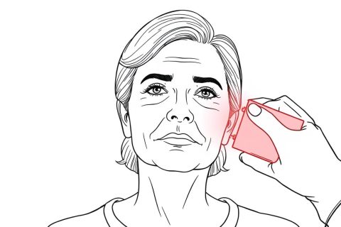 Line drawing of a middle-aged person with Bell's palsy receiving red light therapy treatment on their face